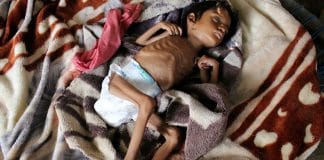 Yémen - un enfant meurt toutes les dix minutes de malnutrition