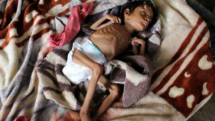 Yémen - un enfant meurt toutes les dix minutes de malnutrition