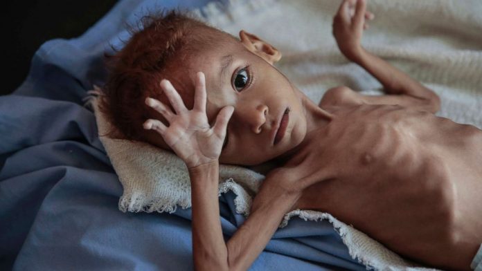 Yémen - la famine menace plus de 2,3 millions d'enfants en 2021