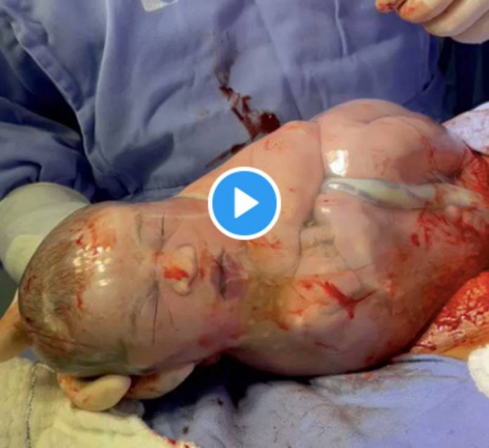 Après un accouchement, des médecins filment un bébé toujours dans la poche des eaux - VIDEO