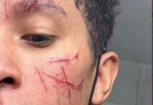 Un homme accuse une dizaine d’hommes racistes de lui avoir scarifié une croix gammée sur le visage avec